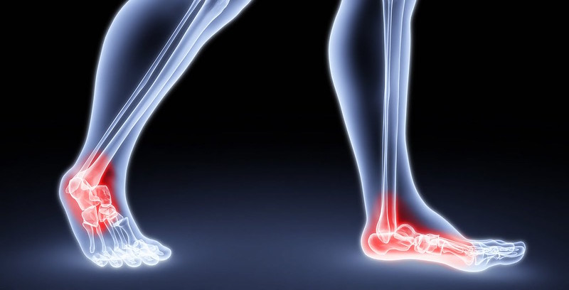Use These Exercises to Help With Foot Pain Relief